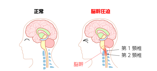 正常　脳幹圧迫　脳幹　第1頸椎　第2頸椎